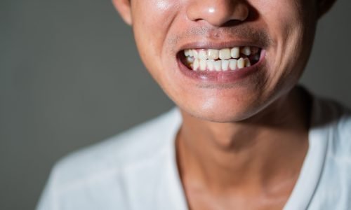 Close-up of a person showing their teeth with a smile, wearing a white shirt.