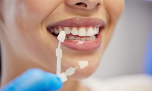 Shot of an unrecognisable woman having her teeth capped at the dentist.